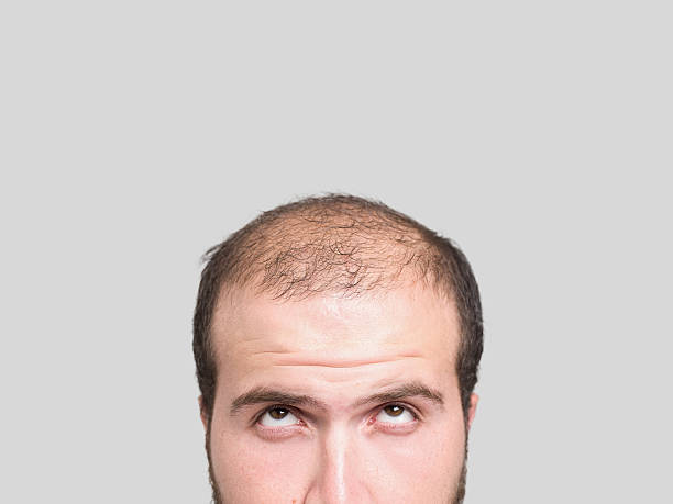 Hair Transplant in Turkey: The Best Doctors and Clinics