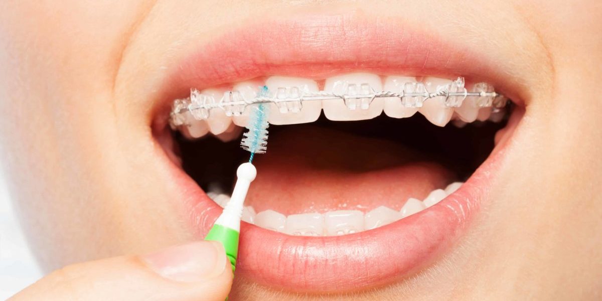 How Many Times Should You Brush Your Teeth With Braces