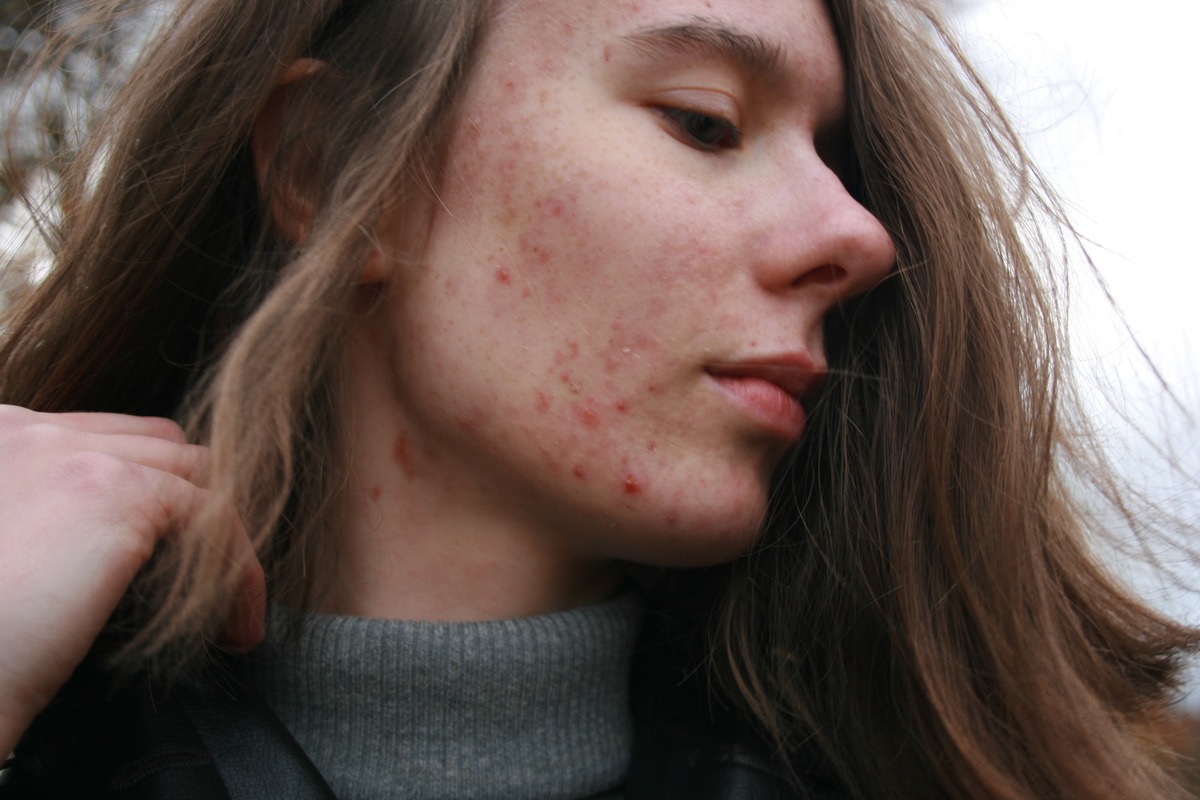 What Essential Oil Is Best For Acne