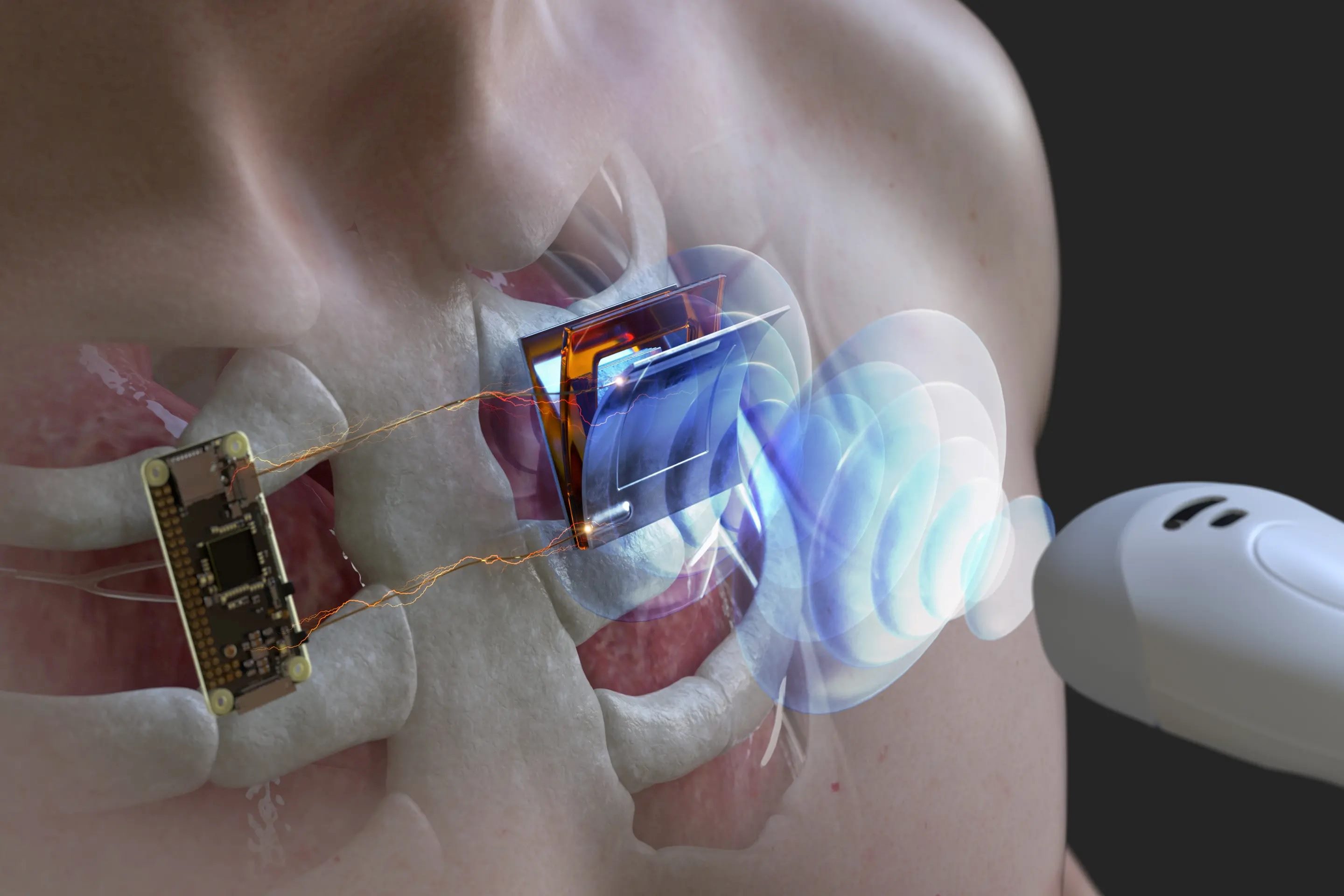 Pacemaker Power Duration: A Guide To Estimating Battery Lifespan