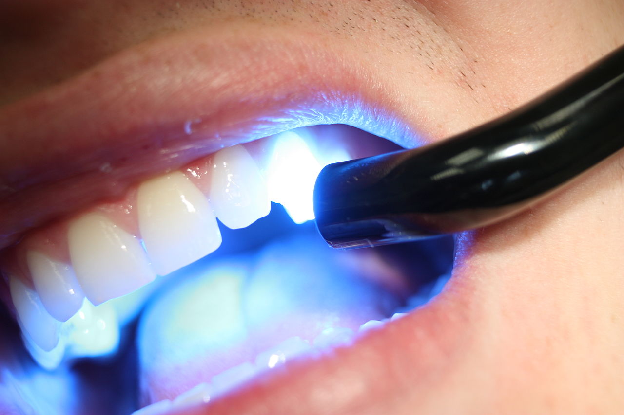 Dental Illumination: Exploring The Blue Light Used By Dentists